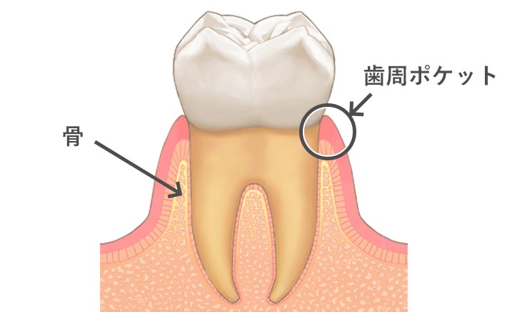 歯周病